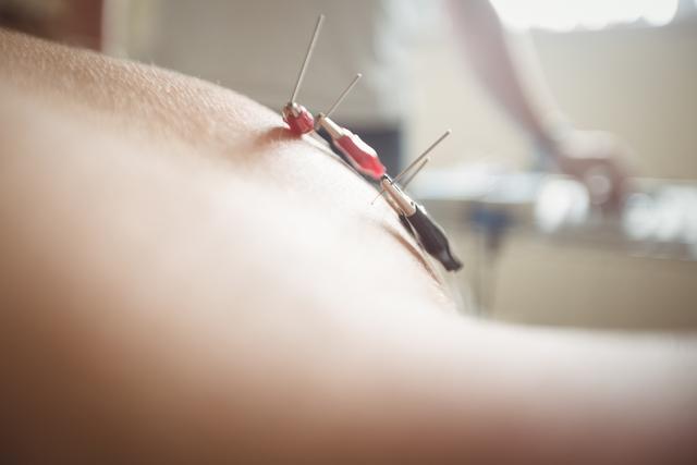 Close-up of patient getting electro dry needling on his shoulder in clinic