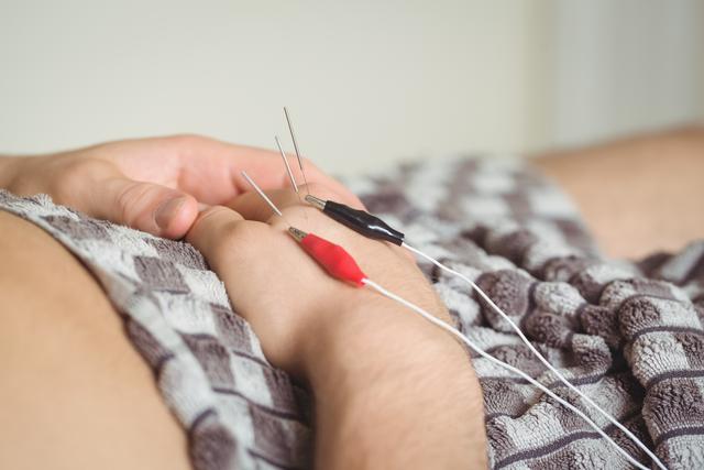 Close-up of a patient getting electro dry needling on hand