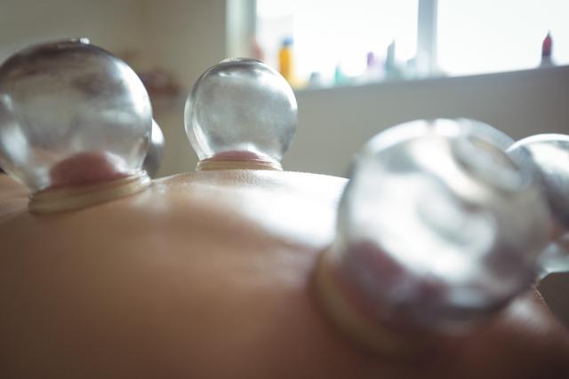 Mid section of man receiving cupping therapy - Download Free Stock Photos Pikwizard.com