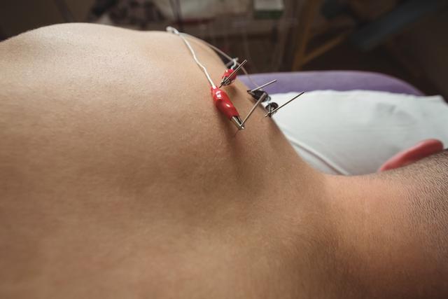 Close-up of patient getting electro dry needling on his shoulder - Download Free Stock Photos Pikwizard.com