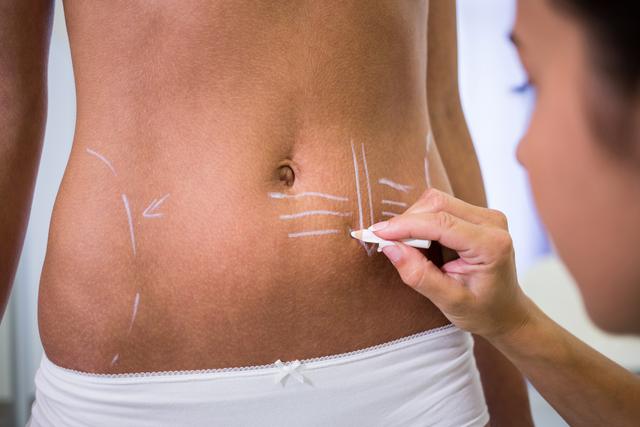 Close-up of surgeon drawing lines on womans abdomen for liposuction and cellulite removal