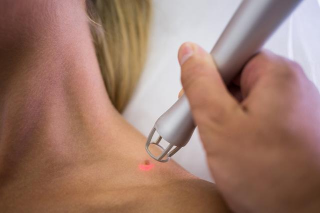 Dermatologist removing mole from womans shoulder - Download Free Stock Photos Pikwizard.com