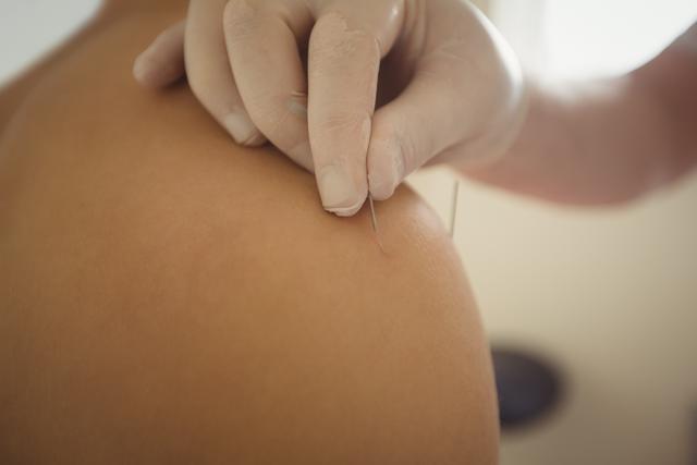 Close-up of physiotherapist performing dry needling on patient - Download Free Stock Photos Pikwizard.com